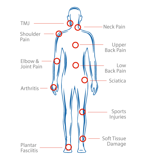 illustration showing various points on the body where laser therapy is most effective
